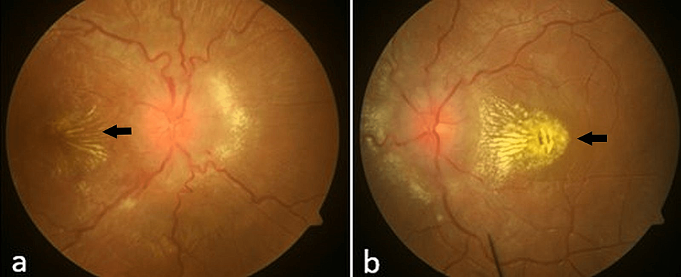 Fundus-photograph-showing-grade-4-hypertensive-retinopathy-with-macular-star-(black-arrows)-in-the-right-eye-(a)-and-the-left-eye-(b)