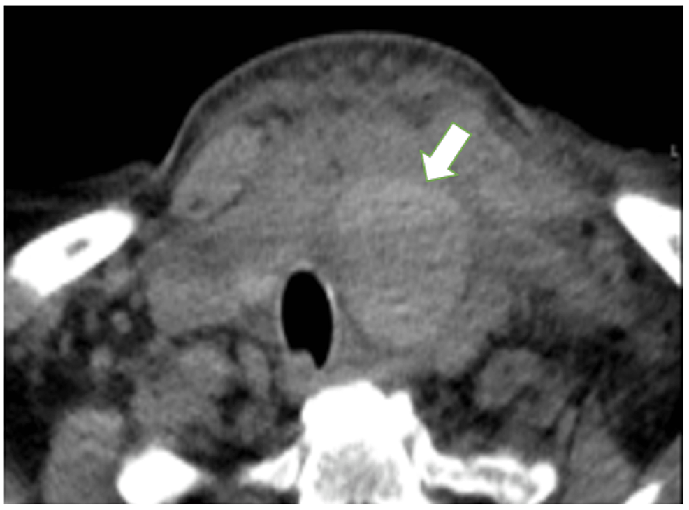 cureus-extracapsular-cervical-hematoma-after-thyroid-fine-needle