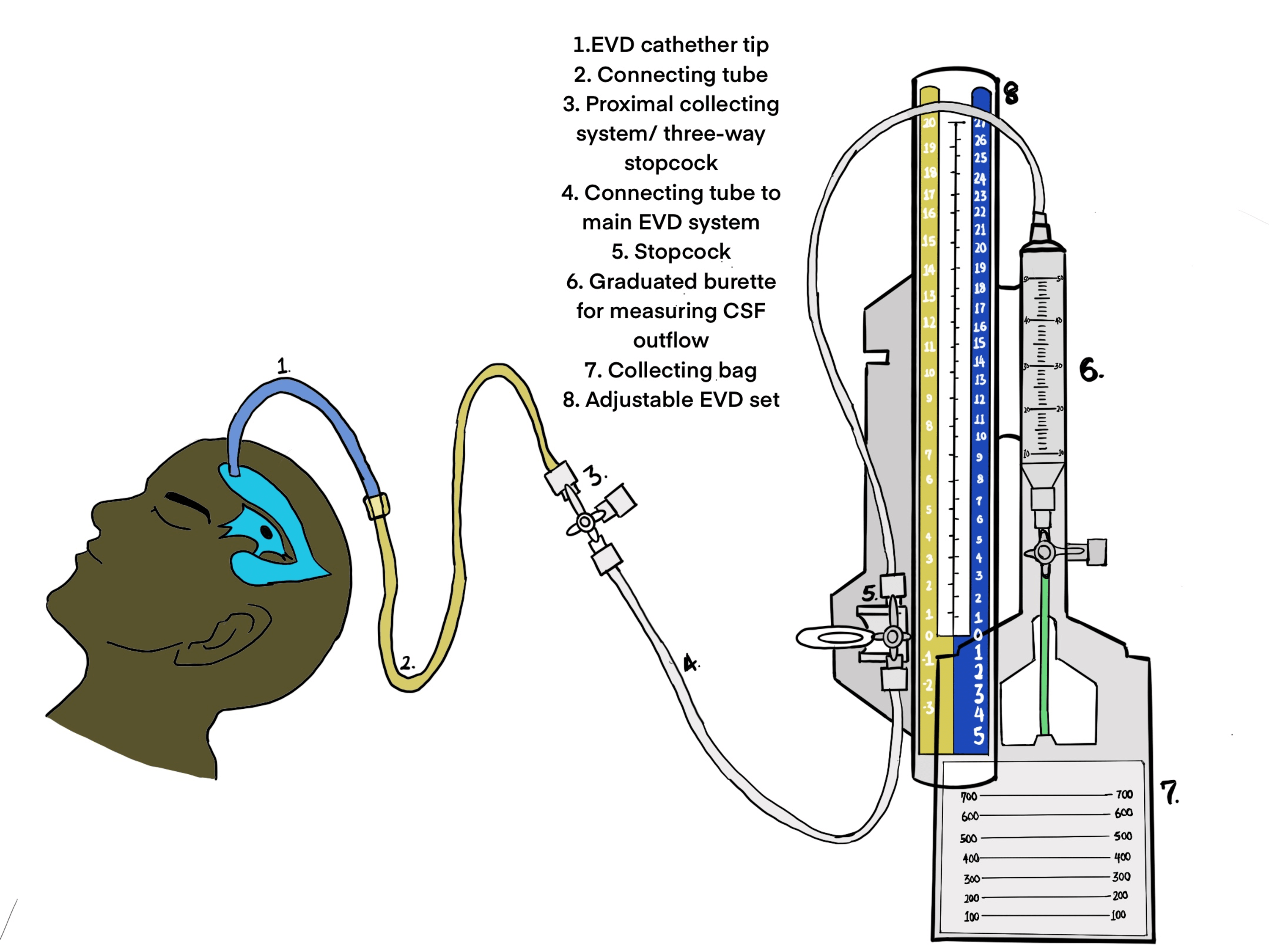 Cureus A Scoping Review of the Use of Improvised External Ventricular