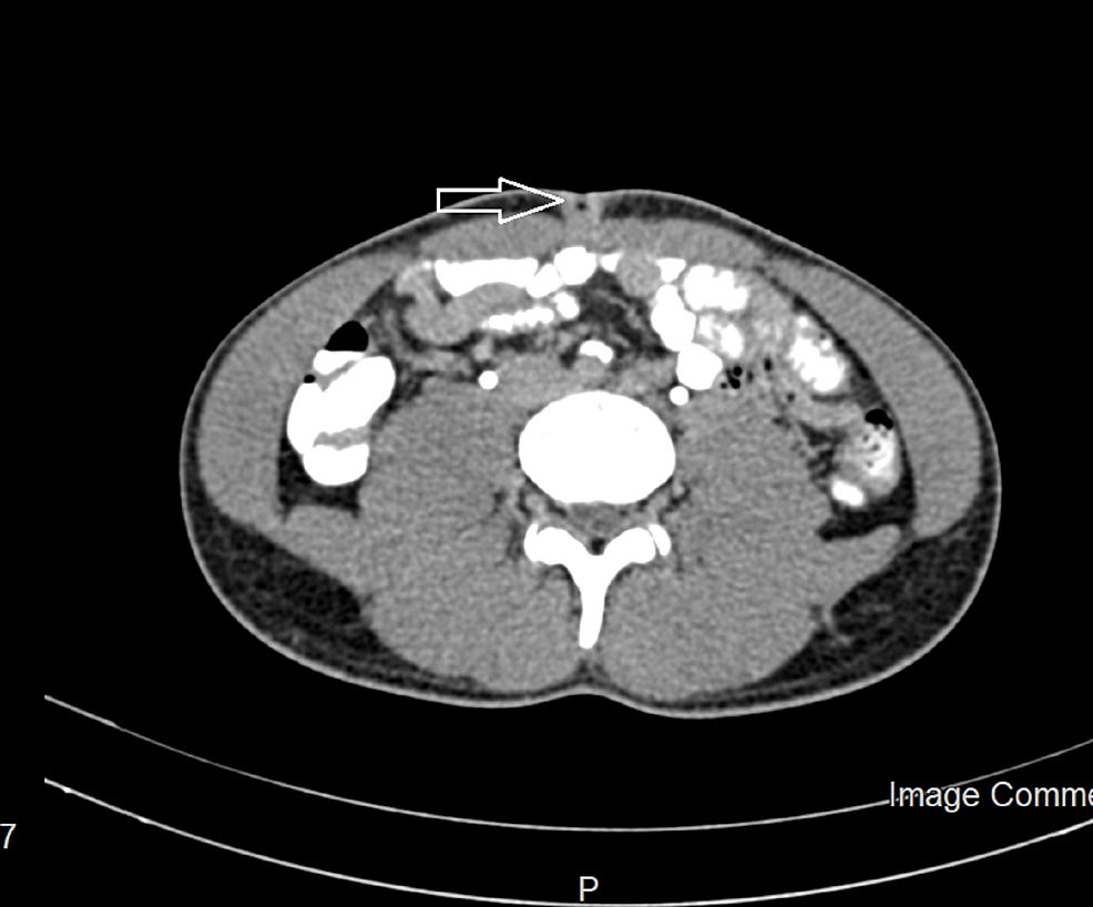 The CT scan shows the urachus sinus at the navel