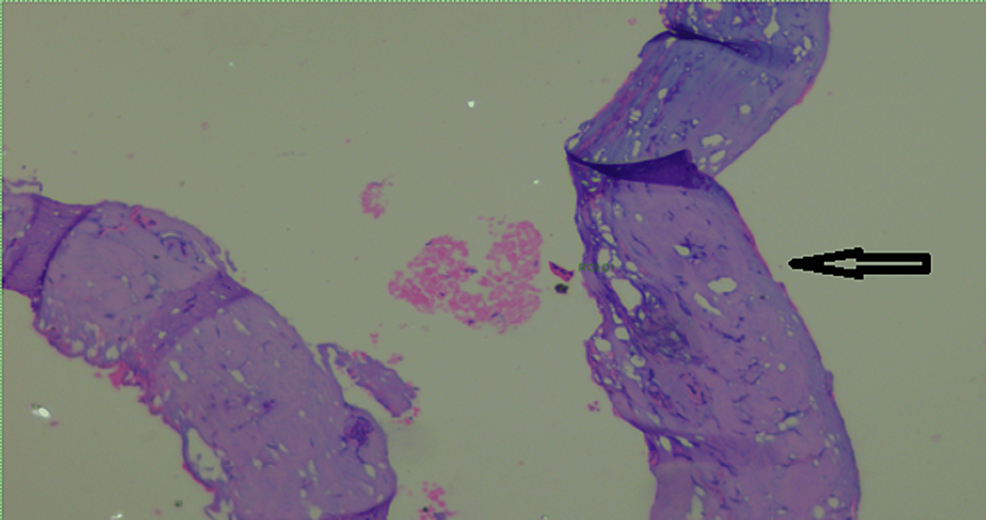 Hematoxylin and eosin stain with atrophic flattened epithelial lining of cyst (40×)