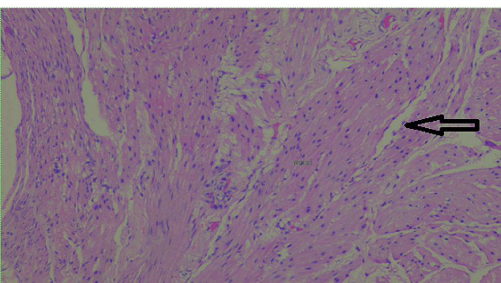 Hematoxylin-and-eosin-staining-with-smooth-muscle-bundles-in-thickened-area-cyst-sections-(400×)
