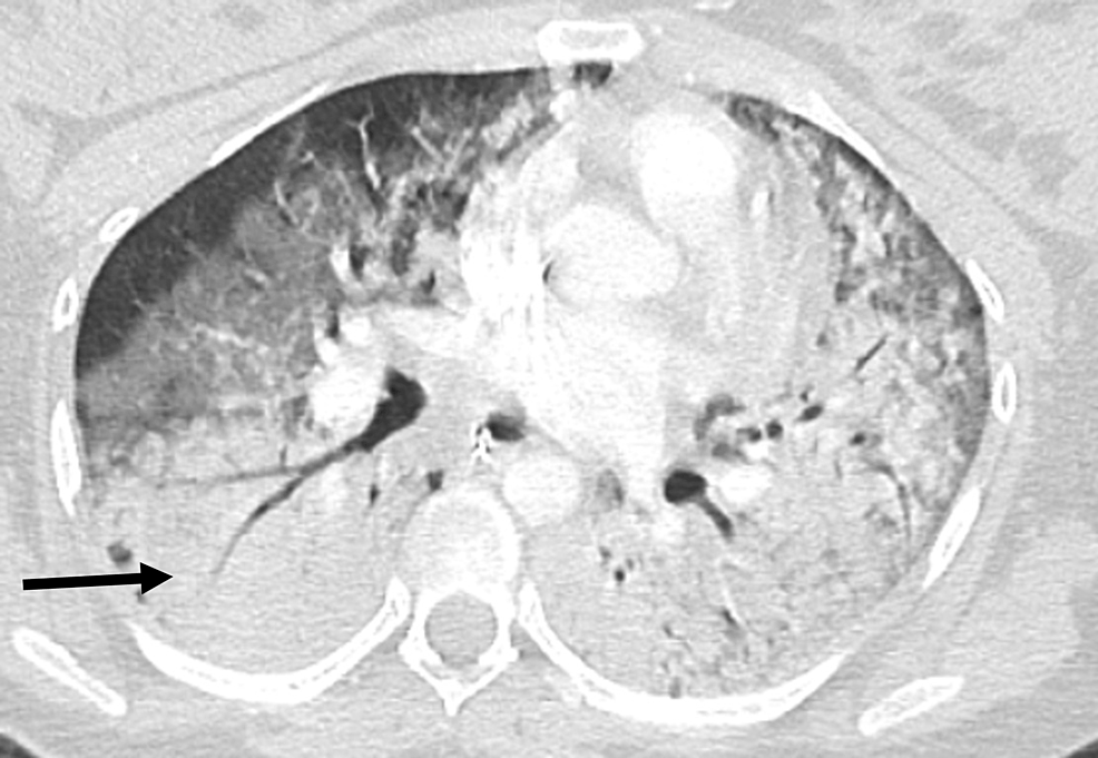 Dense-bilateral-pulmonary-infiltrates-on-CT-scan-chest-indicating-ARDS-(as-indicated-by-the-arrow)