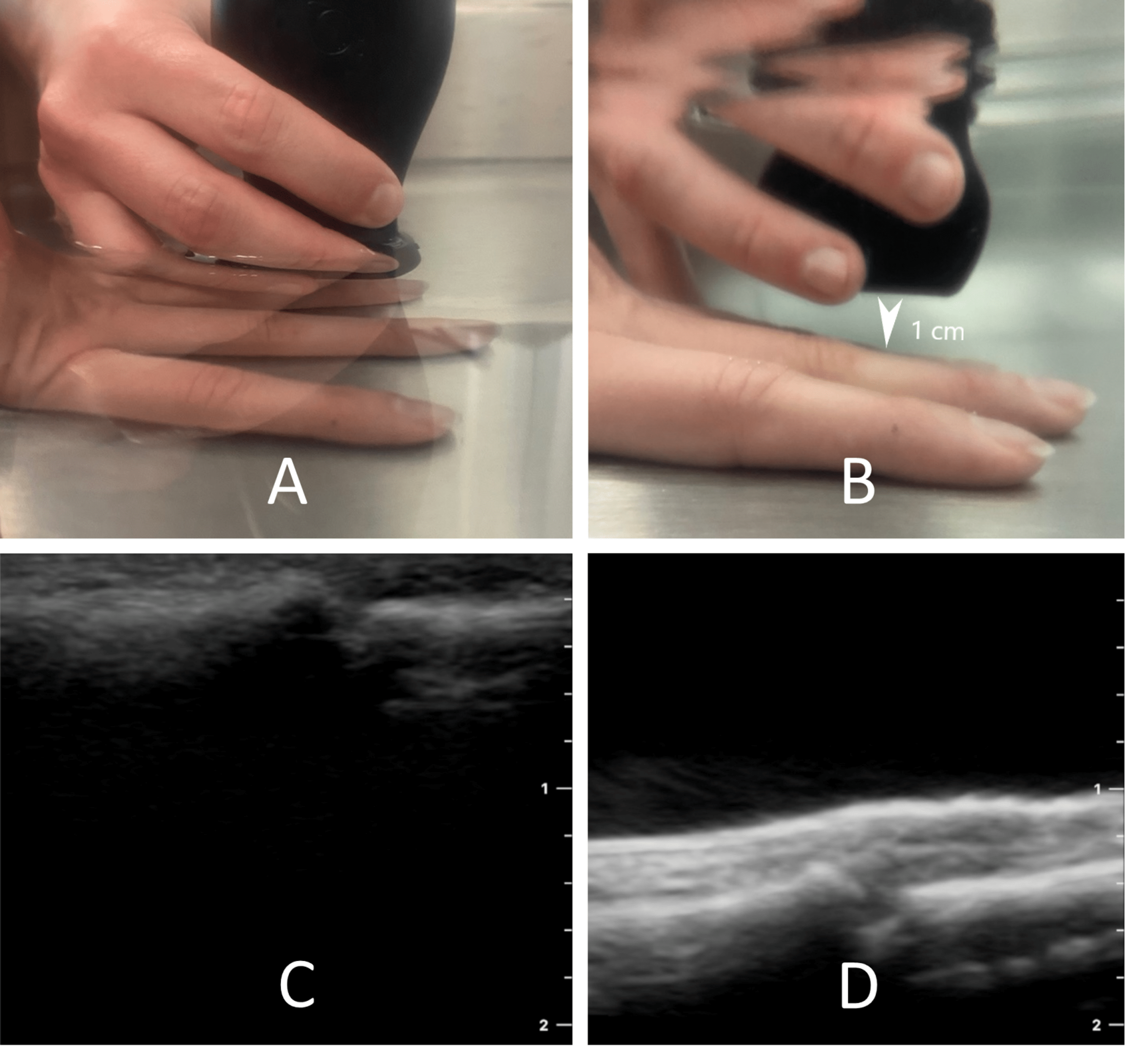 Cureus | Maximizing Foreign Body Detection by Ultrasound With the Water ...