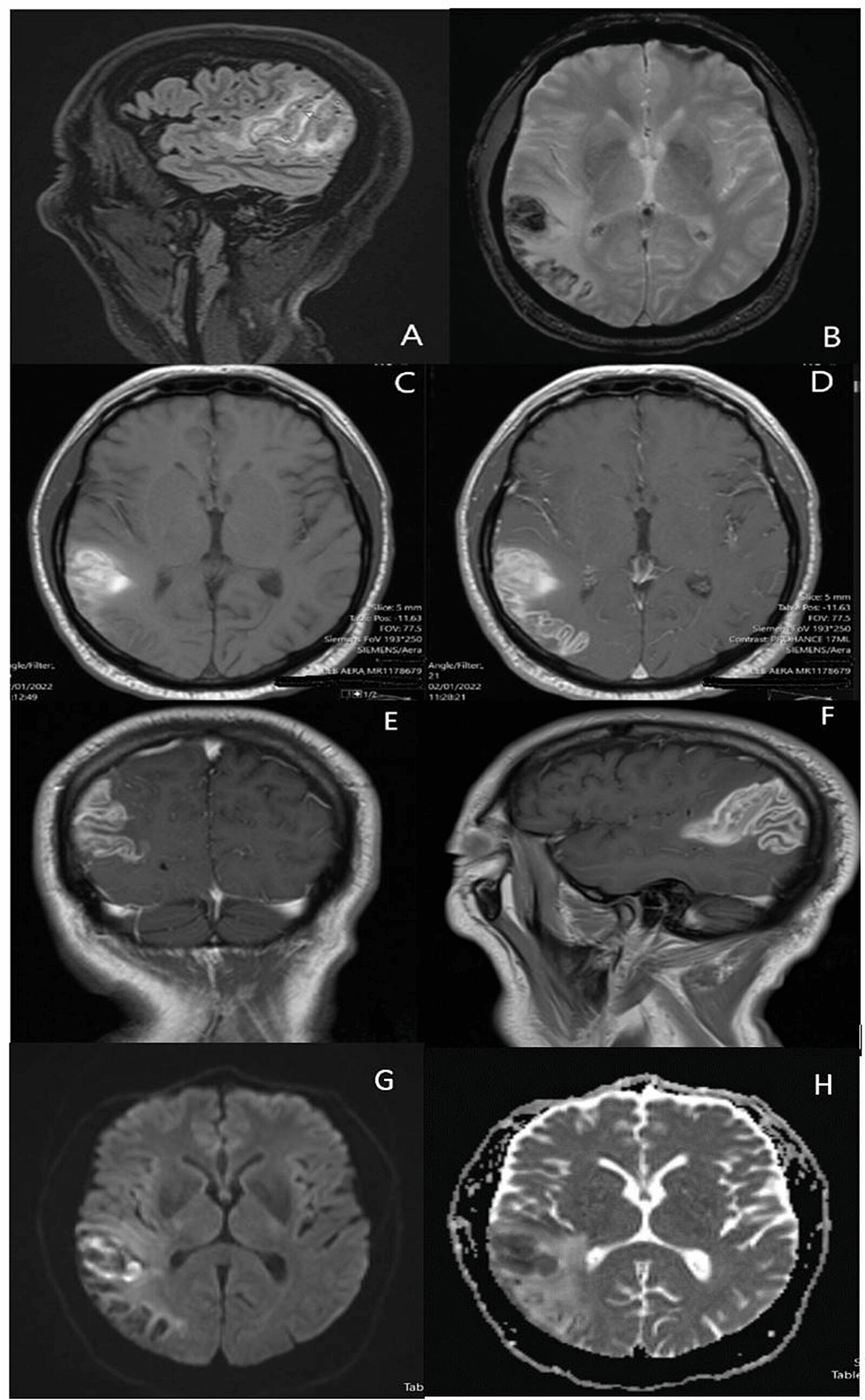 cureus-subpial-hemorrhage-in-an-adult-male