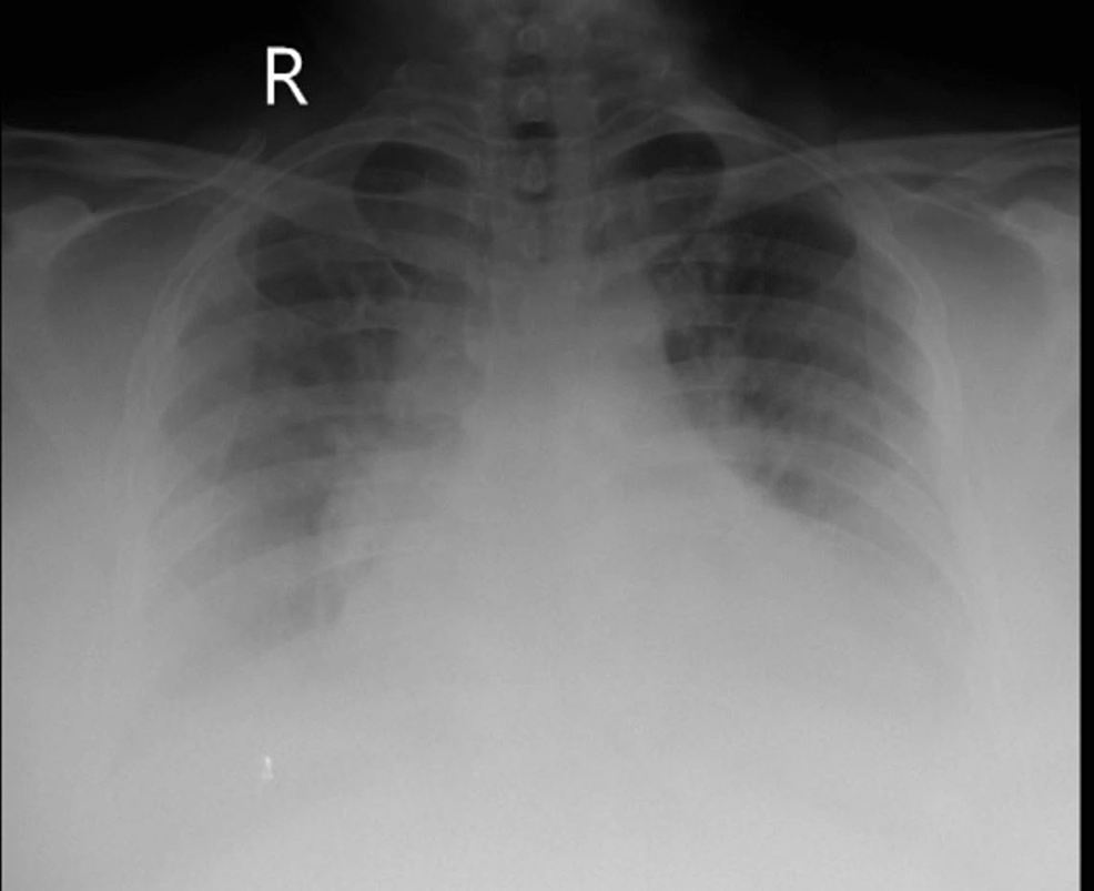 Chest-X-ray-anteroposterior-(AP)-view-suggestive-of-bilateral-lower-zone-haziness