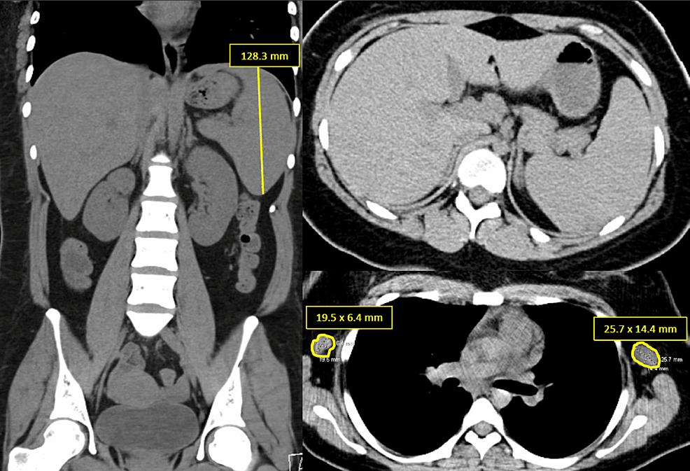 Reactivation Of Human Herpesvirus HHV 6 As Etiology Of Acute Liver reactivation-of-human-herpesvirus-hhv-6-as-etiology-of-acute-liver