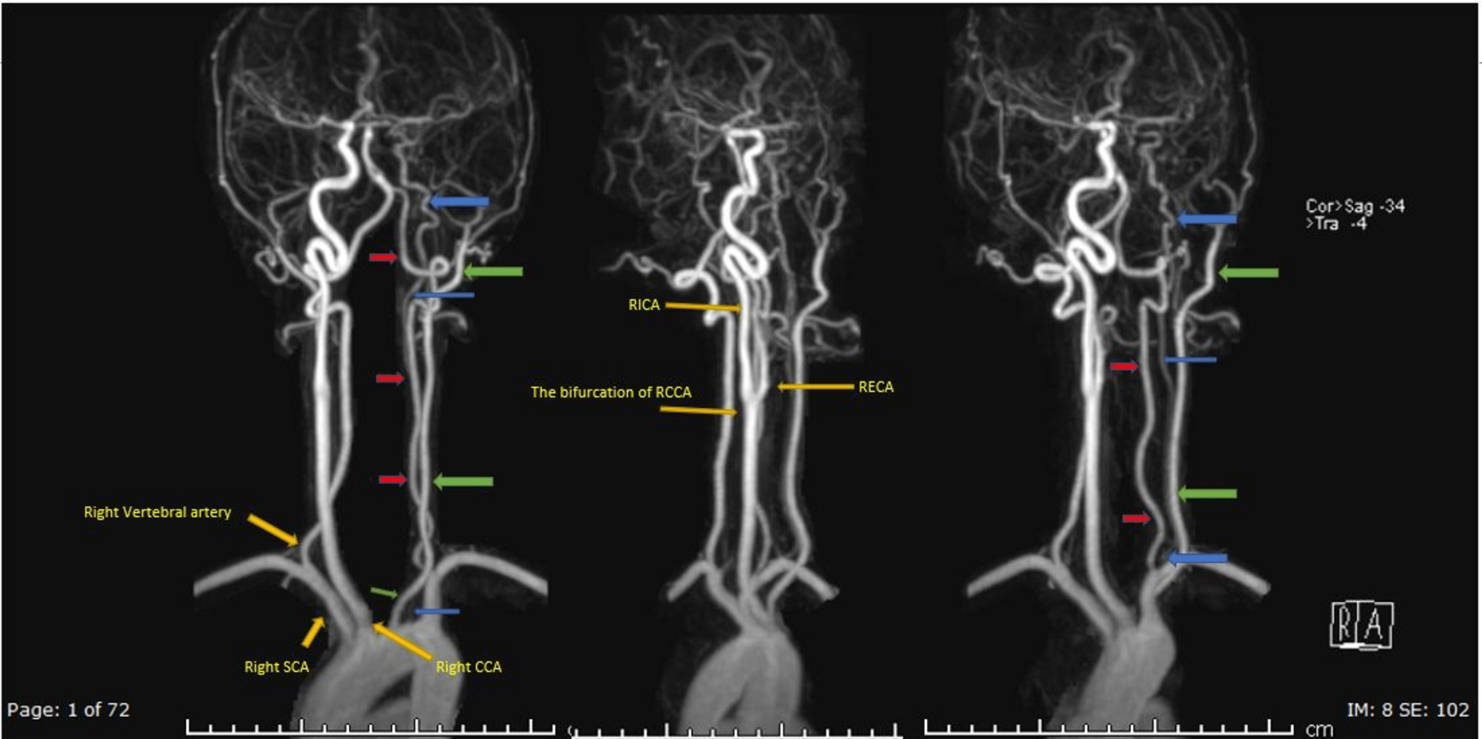 Cureus Left Common Carotid Artery Agenesis With Independent Origins