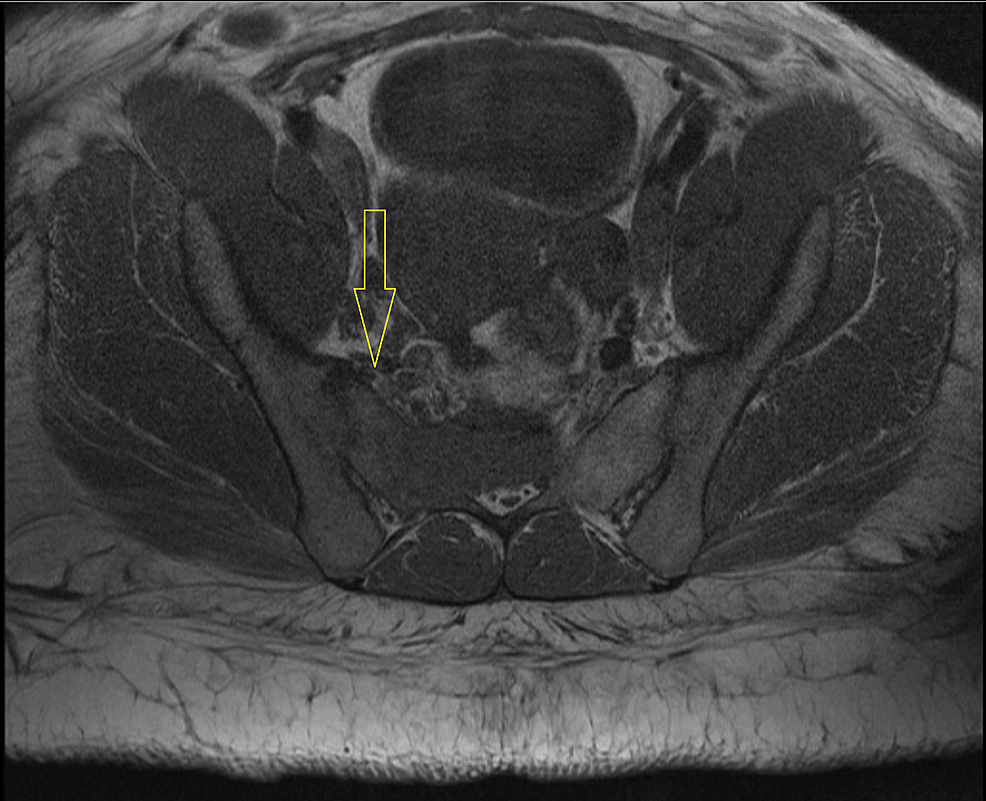 Imagen de resonancia magnética de la columna lumbar que muestra una masa sacra ubicada principalmente en el centro.