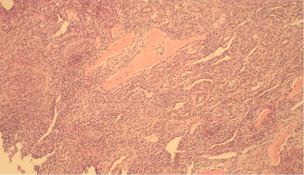 Biopsia central del hueso que muestra proliferación vascular extensa (hematoxilina y eosina, -10x).