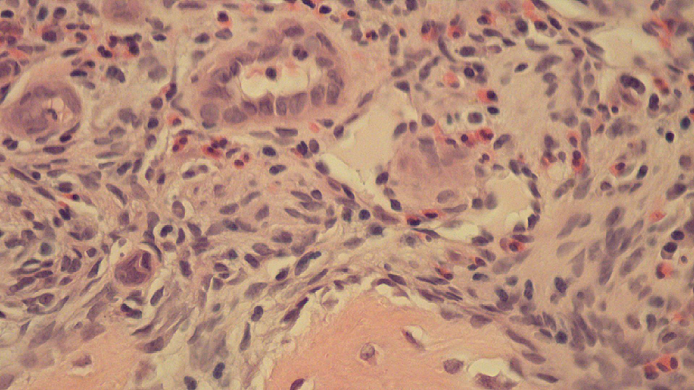 Hueso que muestra proliferación vascular con aumento de eosinófilos (hematoxilina y eosina, -50x).