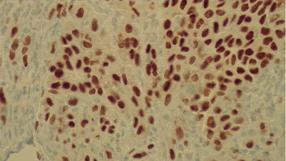 ERG-inmunohistoquímica-tinción-confirmación-células endoteliales-(inmunohistoquímica,-50x).