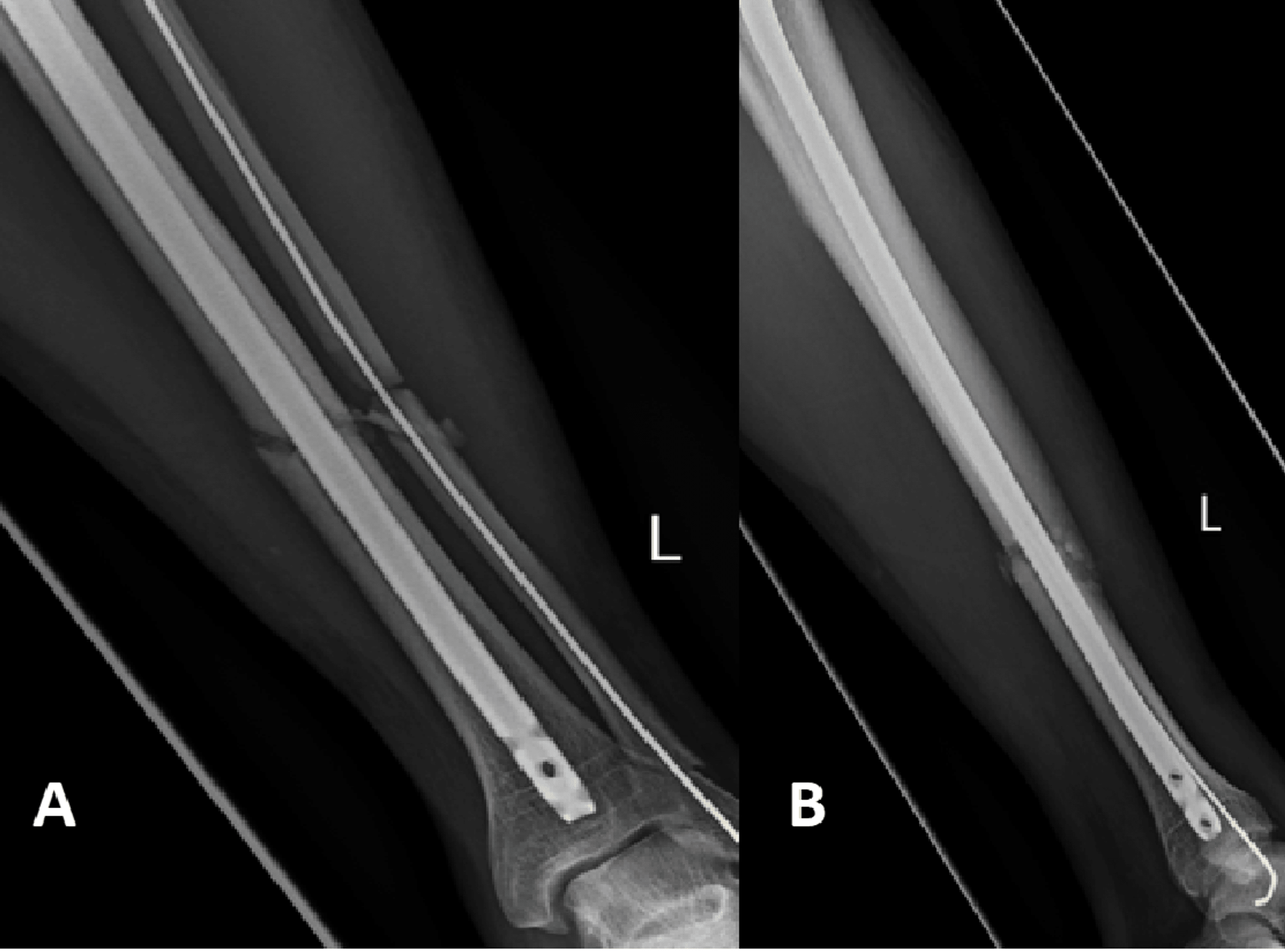 Cureus A Retrospective Study Is LowIntensity Pulsed Ultrasound