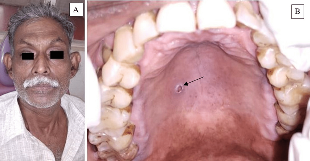 A.-Extraoral-examination-did-not-reveal-any-facial-asymmetry.-B.-Intraoral-examination-revealed-an-ulcer-of-dimension-about-0.5-x-1-cm-in-diameter-with-a-necrotic-base-on-the-right-posterolateral-region-on-the-hard-palate.