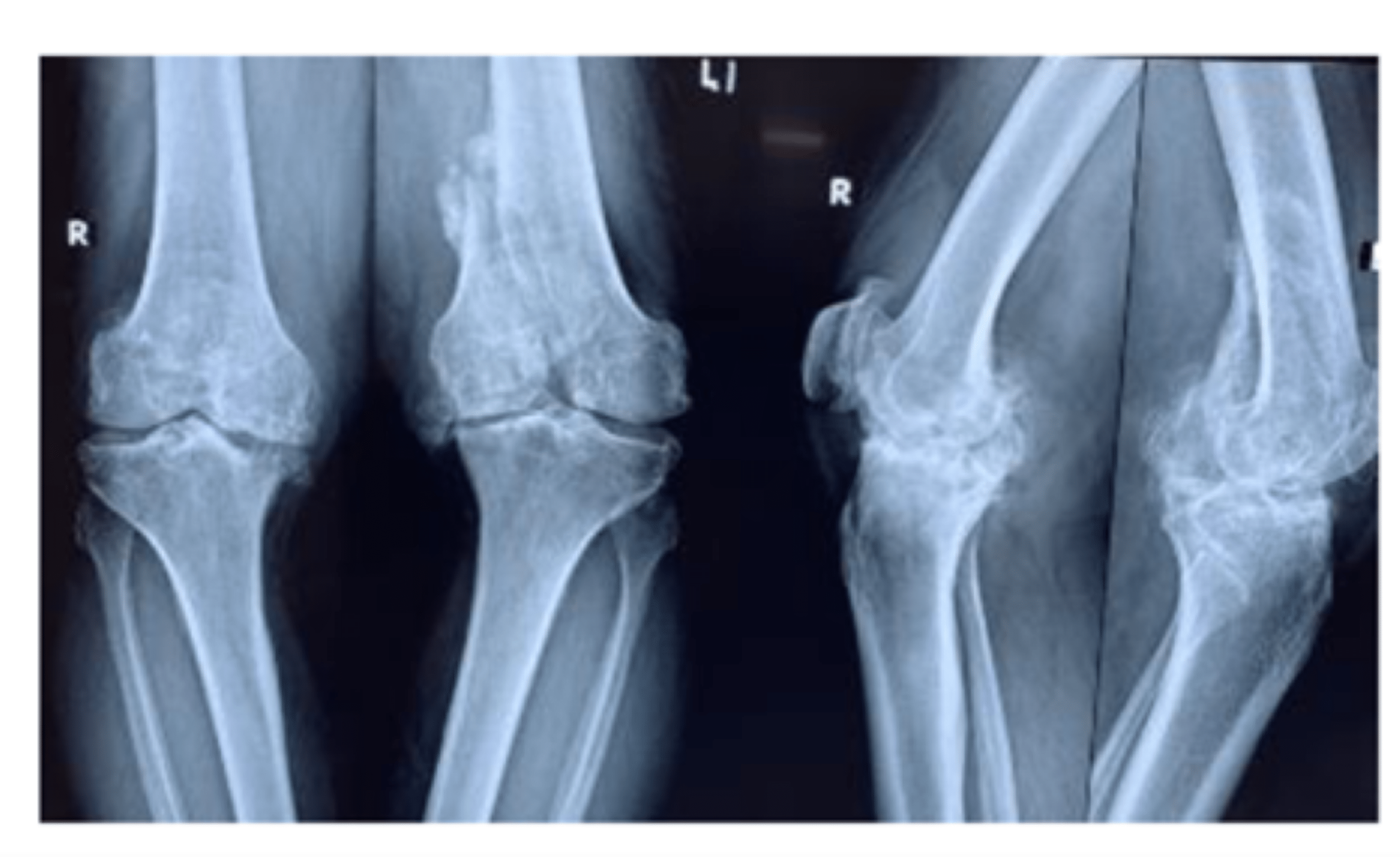 Cureus Distal Femur Intraarticular Fracture in a Late Arthritic Knee