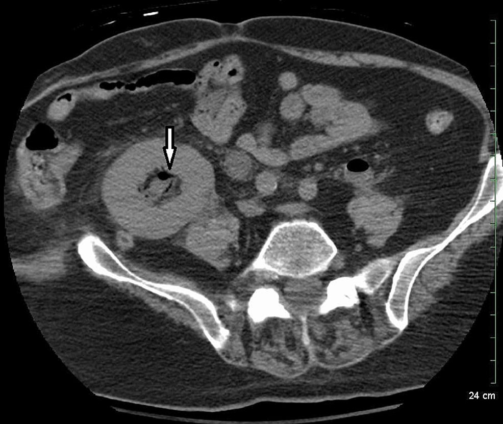 Cureus Emphysematous Pyelonephritis Involving Native Kidneys and a Transplanted Kidney