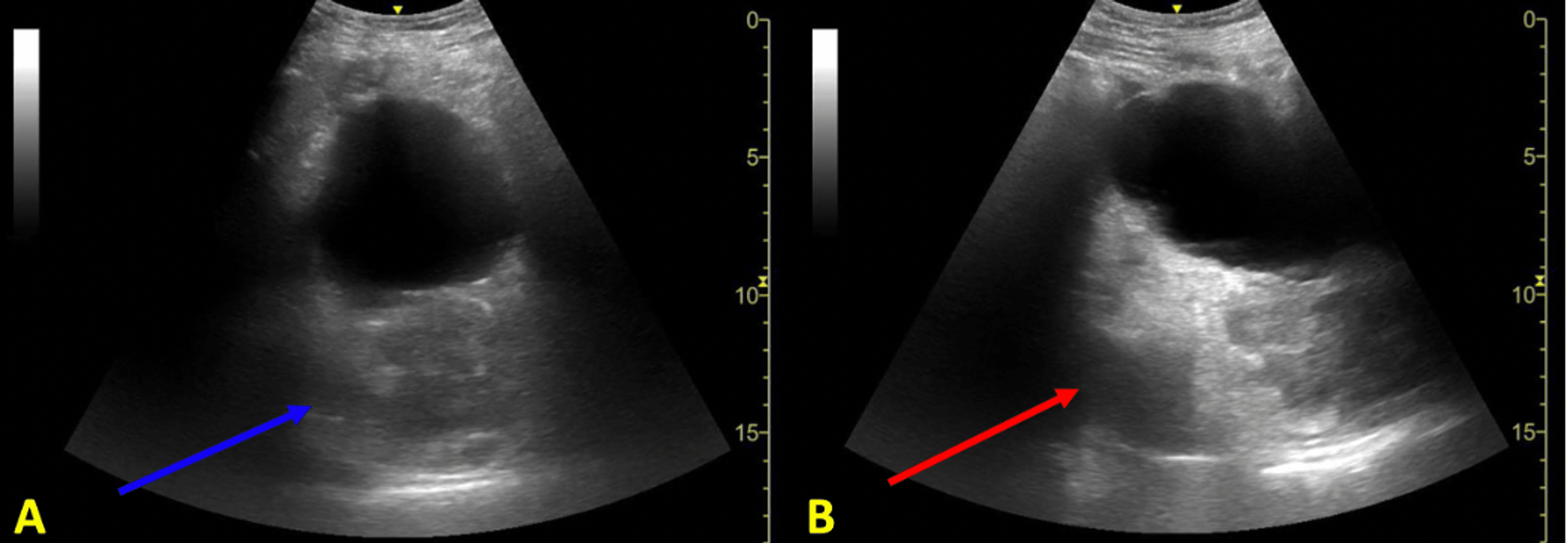 Cureus Emergency Department Point Of Care Ultrasound Diagnosis Of A