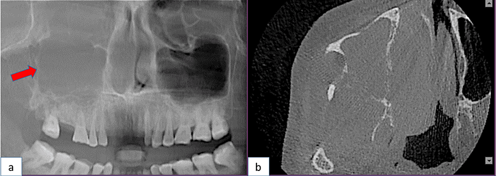 (a)-An-orthopantomography-showing-a-ground-glass-appearance,-radiopaque-in-nature.-(b)-The-axial-view-reveals-right-maxillary-sinus-obliteration,-along-with-breach-in-the-posteromedial-wall,-anterolateral-wall,-and-medial-walls-of-the-maxillary-sinus.