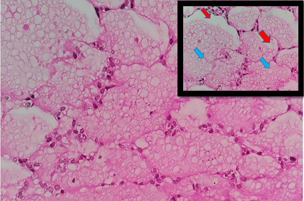 Follicular-pattern-with-central-eosinophilic-material-with-presence-of-clear-(blue-arrows)-to-vacuolated-(red-arrows)-cytoplasm-(H&E,-400x)