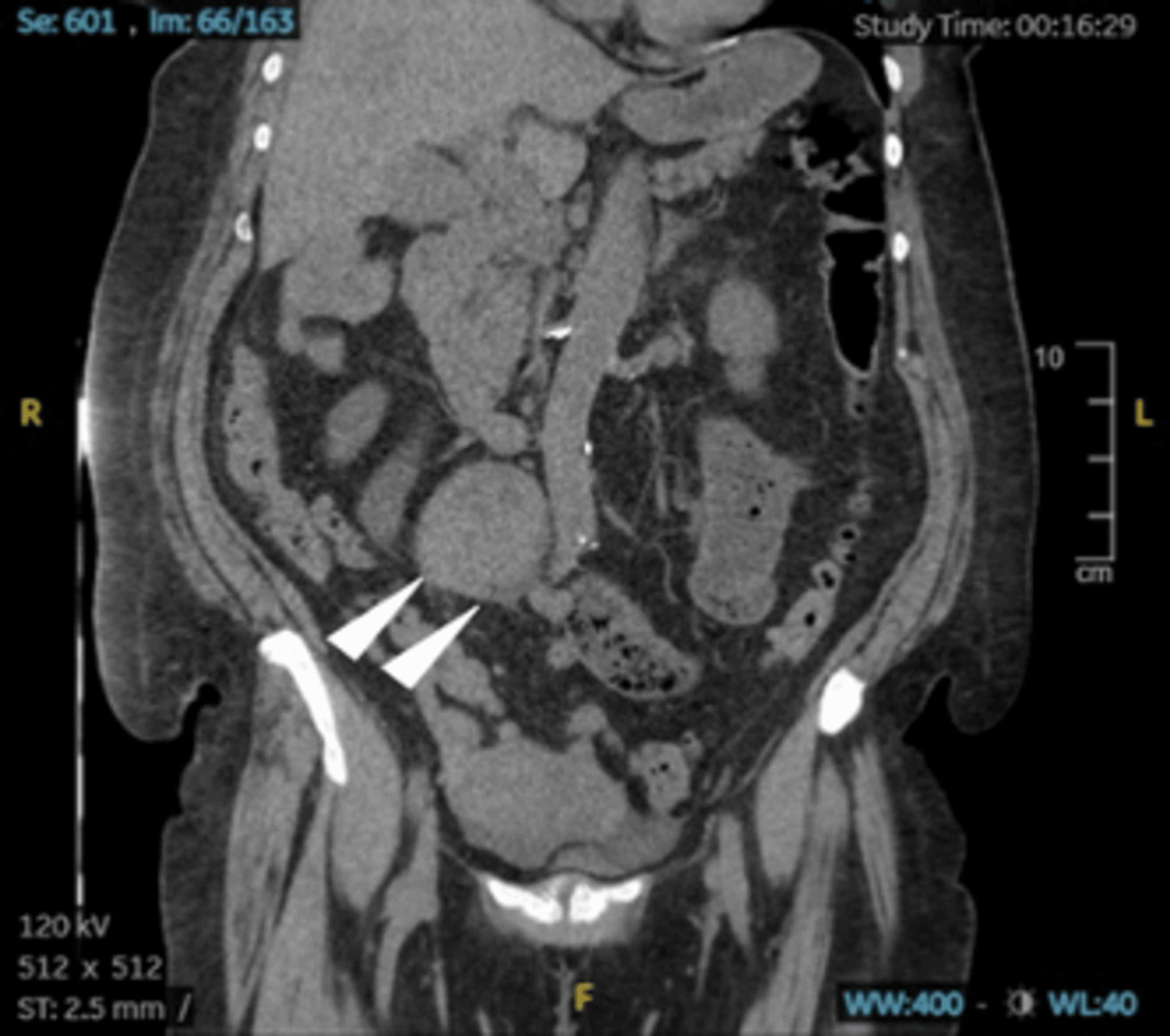 Cureus | Unresectable Mesenteric Mass Causing Small Bowel Obstruction