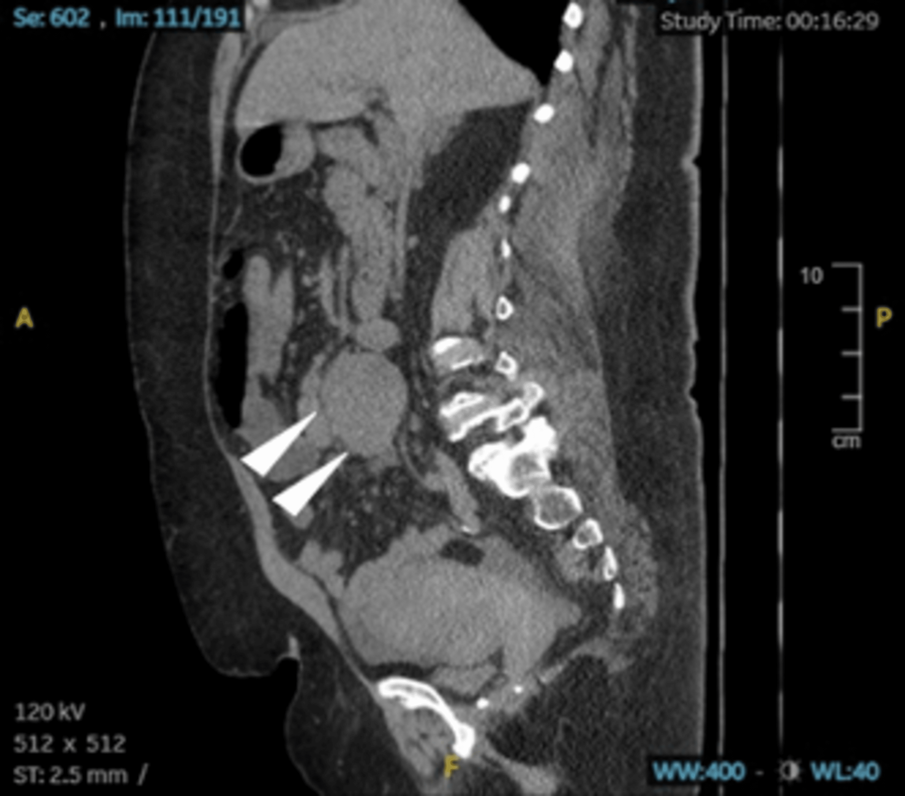 Cureus | Unresectable Mesenteric Mass Causing Small Bowel Obstruction