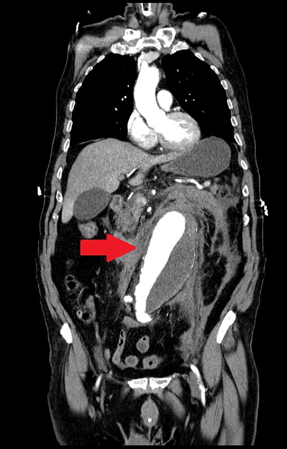 Can Thyroid Medicine Cause Abdominal Pain