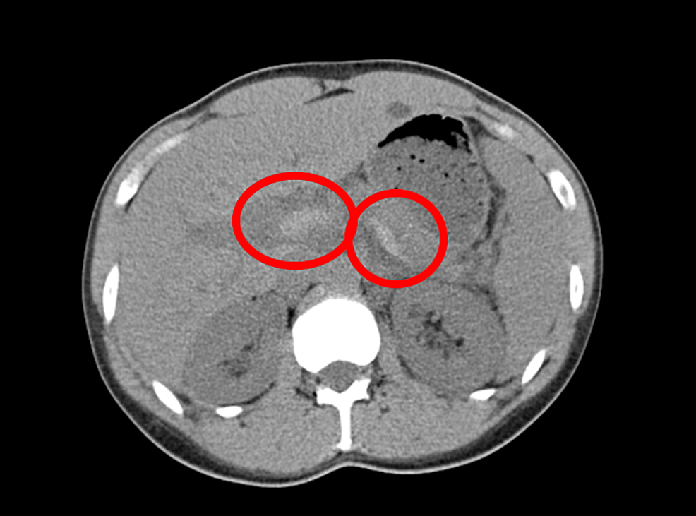 Abdominal CT scan showing splenic thrombosis and portal vein (circle)