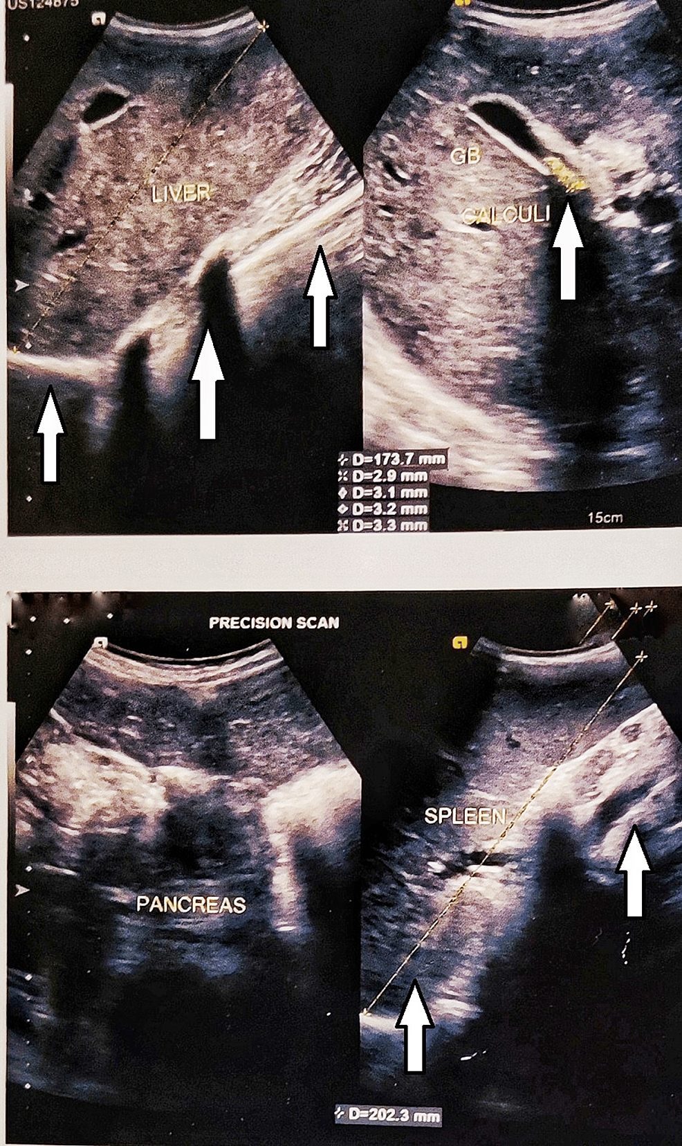Ultrasonography-of-the-abdomen-reveals-enlarged-liver-with-a-size-of-17.3-cm,-an-enlarged-spleen-with-a-size-of-20.2-cm,-and-multiple-calculi-at-the-neck-of-the-gall-bladder measuring-6-×-6-mm-in-size