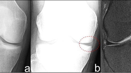 cureus meniscal radiographic extrusion