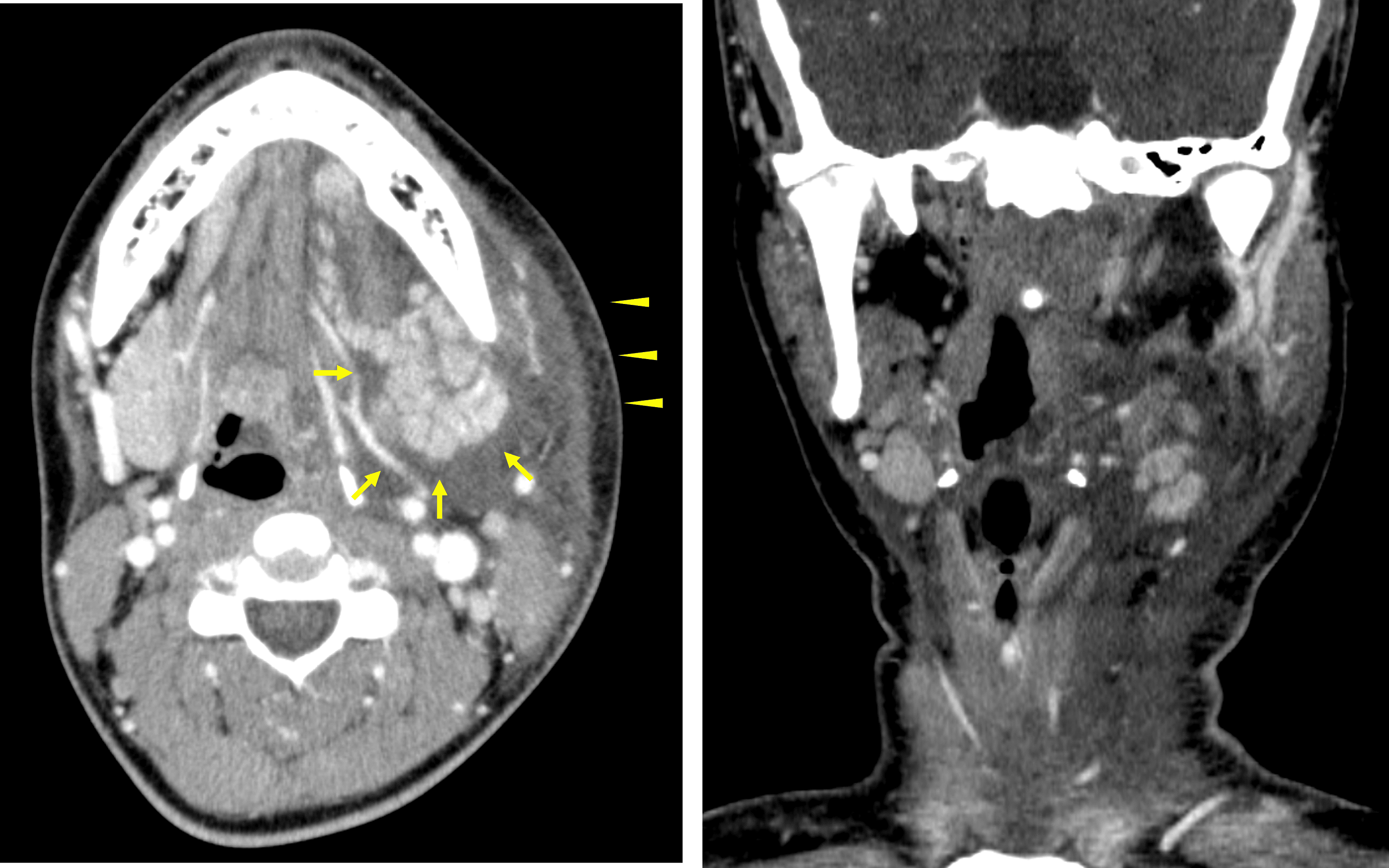 Cureus | A Case of Mumps Presenting With Unilateral Submandibular ...