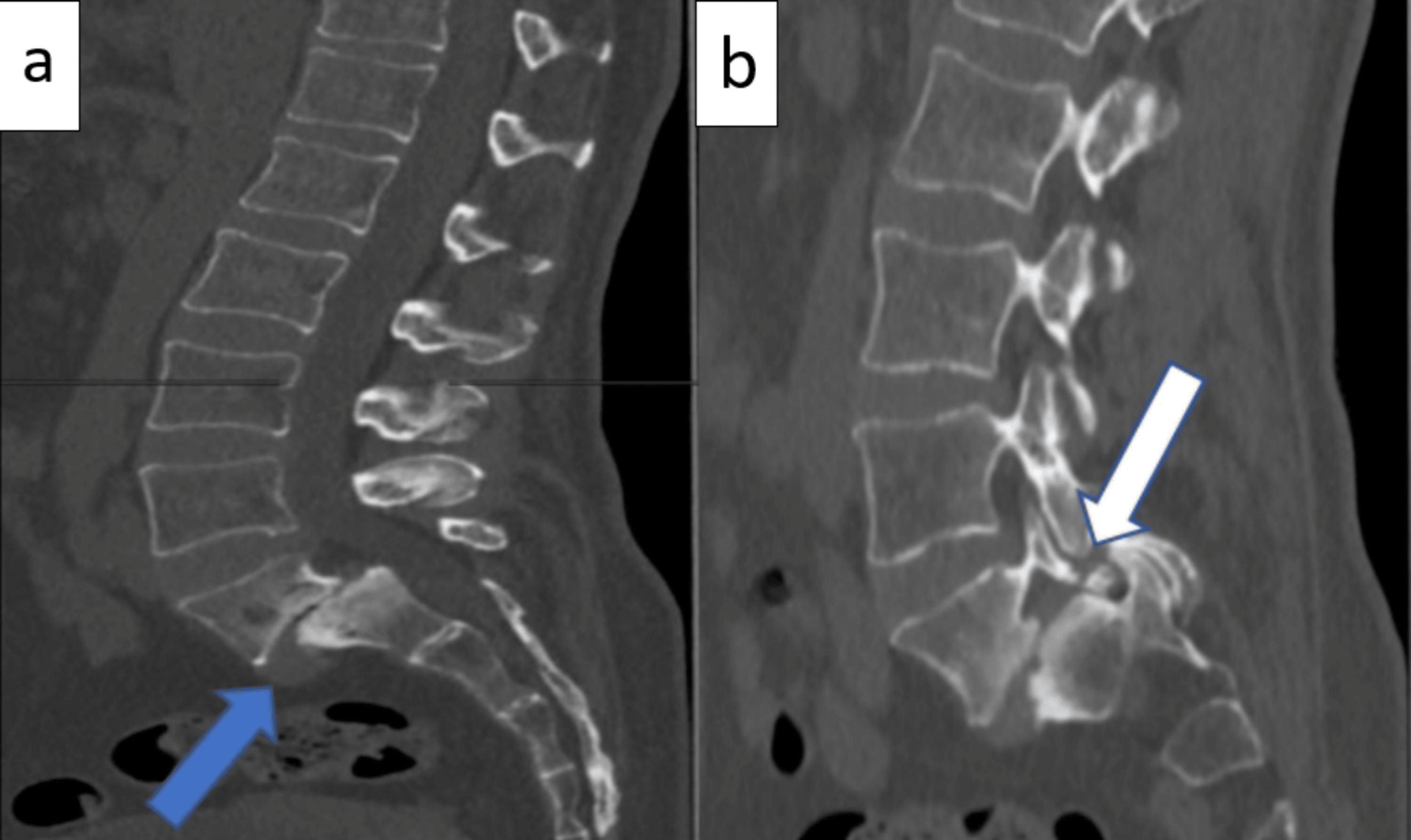 Cureus | Degenerative Grade 3 Spondylolisthesis Management: A Case ...