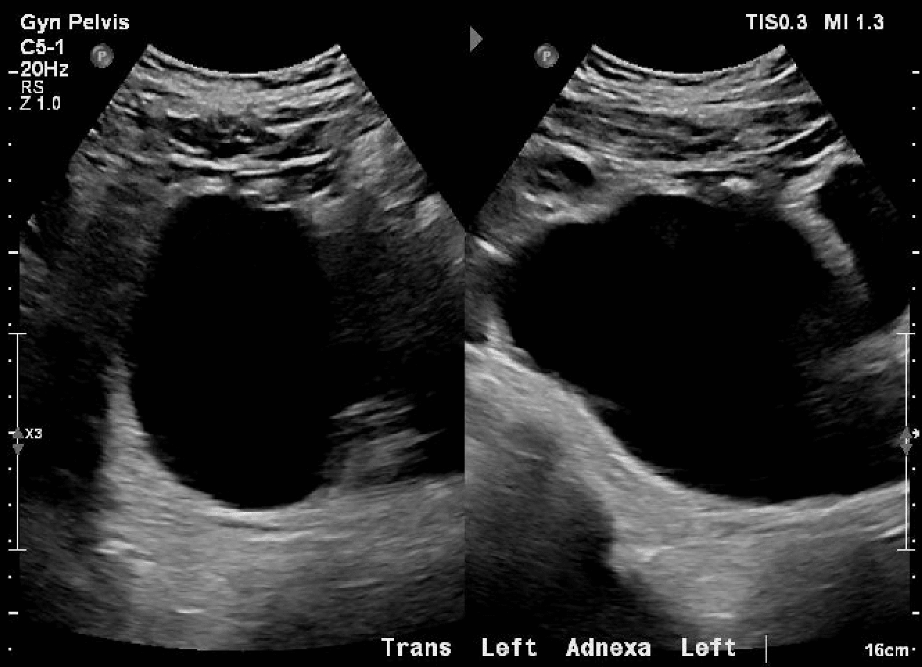 Cureus Left Ovarian Cyst With Overlying Sigmoid Colon