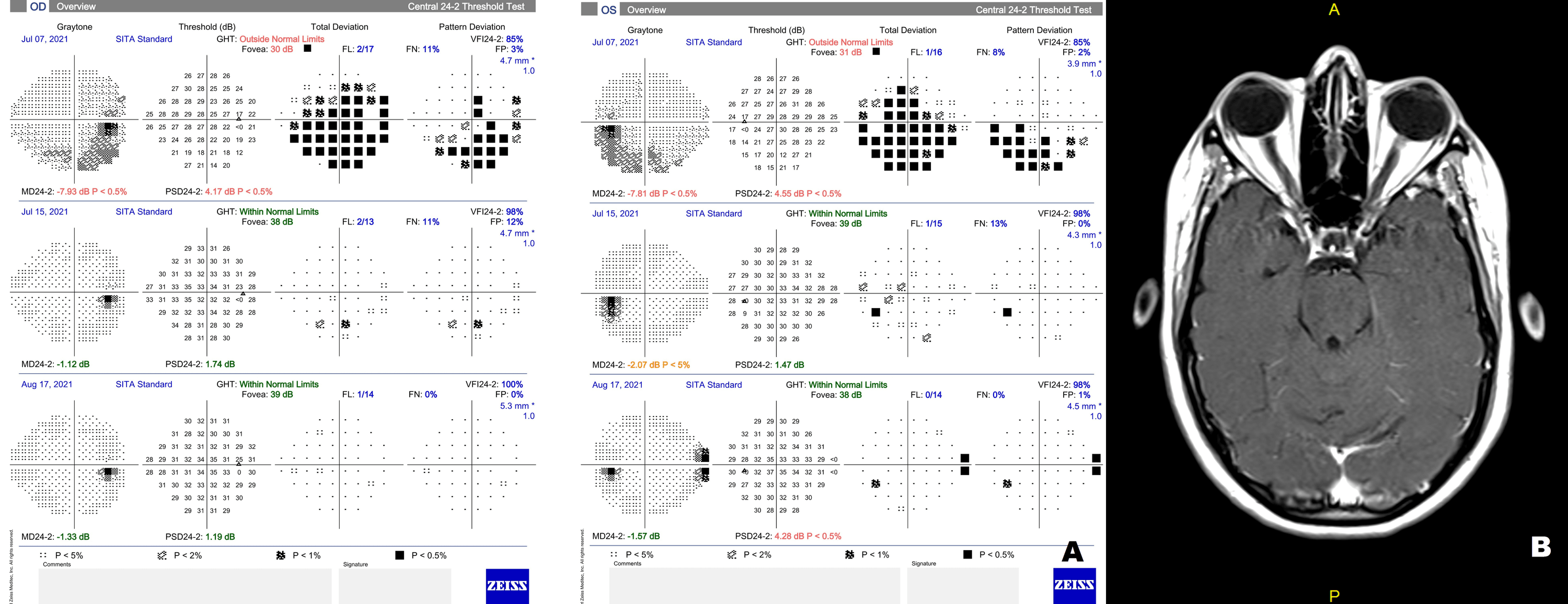 Cureus Bilateral Optic Neuritis And Facial Palsy Following Covid 19 Infection Cureus Bilateral Optic Neuritis And Facial Palsy Following Covid 19 Infection