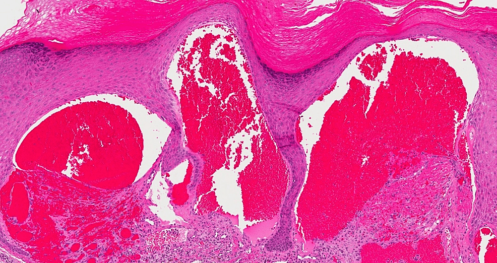 Cureus Unilateral Angiokeratoma Of Fordyce With Unilateral Peaker A