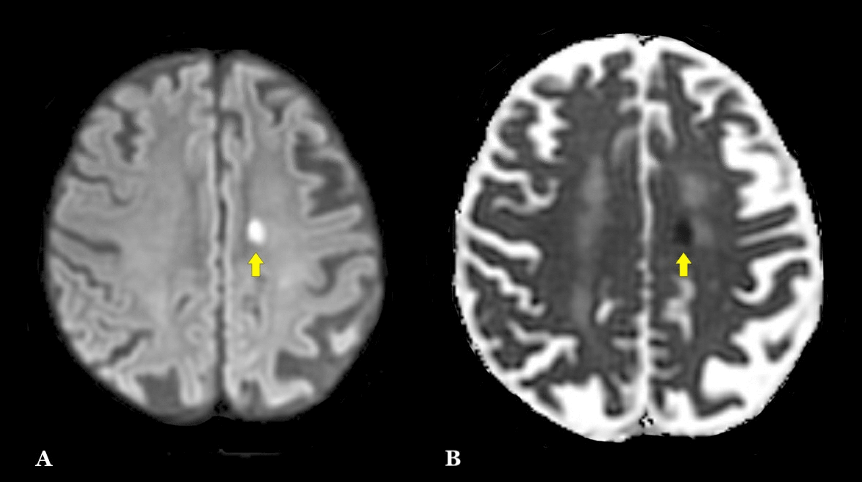Cureus Music to the Ears An Unusual Case of Frontal Lobe Stroke With
