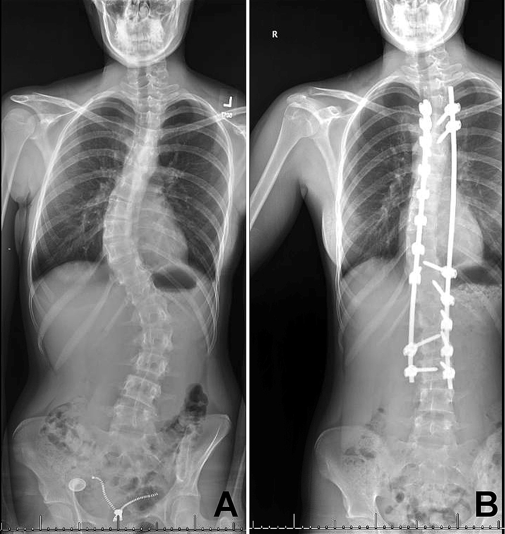 Preoperative-(A)-and-postoperative-(B)-anteroposterior-scoliosis-radiographs