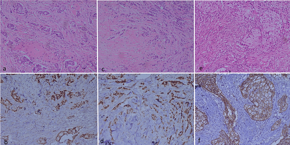 Relationship of Tubule Formation, Indian File Pattern and Apocrine Change With Estrogen and Progesterone Receptors and HER2 Immunostaining