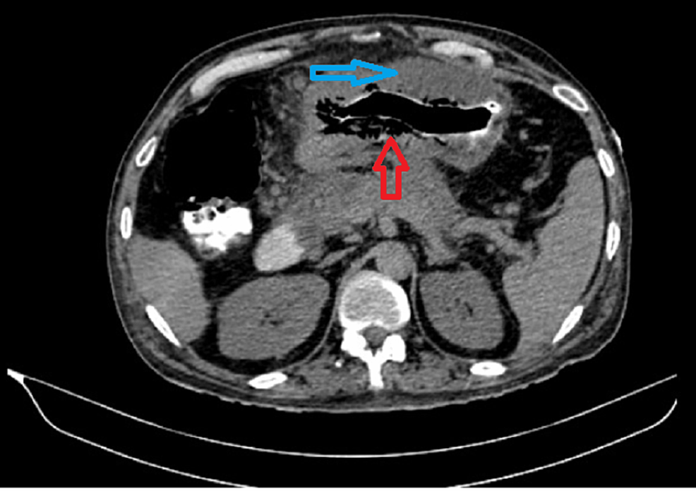 Cureus Emphysematous Gastritis A Lethal Complication in a Patient With Pancreatitis