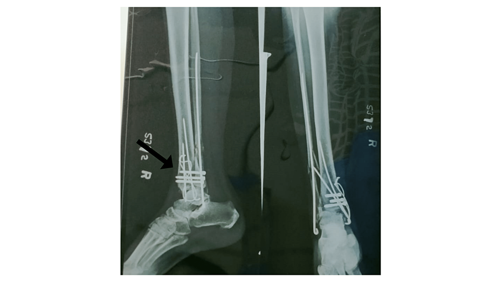 Post-operative-X-ray-of-the-right-ankle-in-anteroposterior-(AP)-view-and-lateral-view-showing-the-trimalleolar-fracture-(black-arrow)-managed-with-open-reduction-and-internal-fixation-using-a-rush-nail-and-cannulated-cancellous-screw.