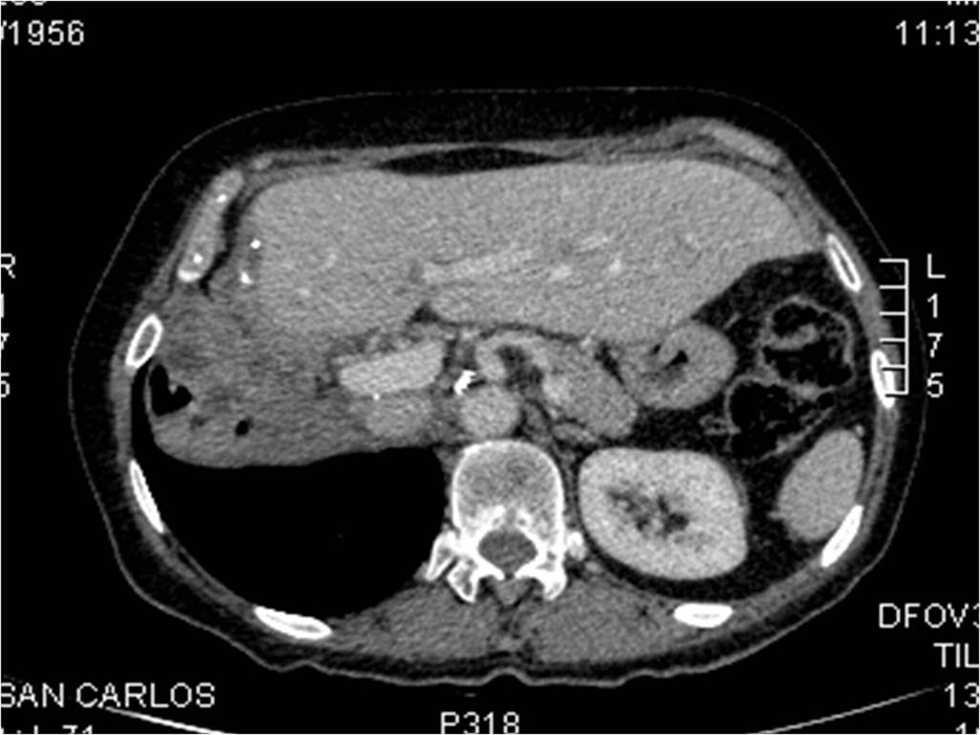 Cureus Complete Remission in Metastatic Pheochromocytoma Treated with