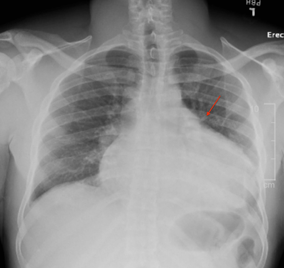 Chest-X-ray-demonstrating-a-widened-mediastinum.