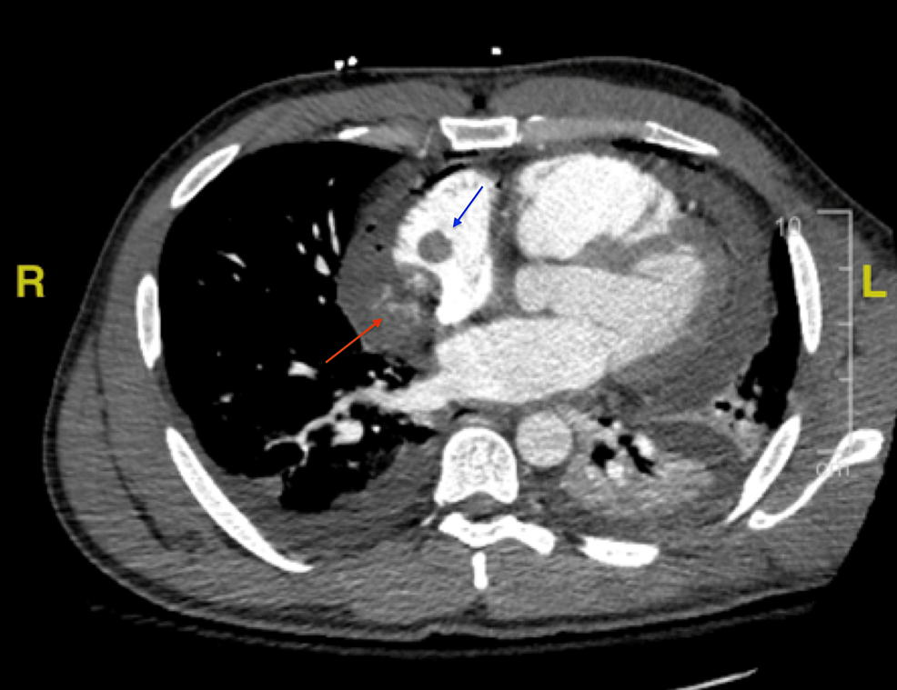 CTA-chest-depicting-small-amount-of-heterogeneous-hyperdense-material-along-the-medial-aspect-of-the-right-atrium-(red-arrow)-and-a-1.4-cm-mass-at-the-superior-medial-aspect-of-the-right-atrium-(blue-arrow).