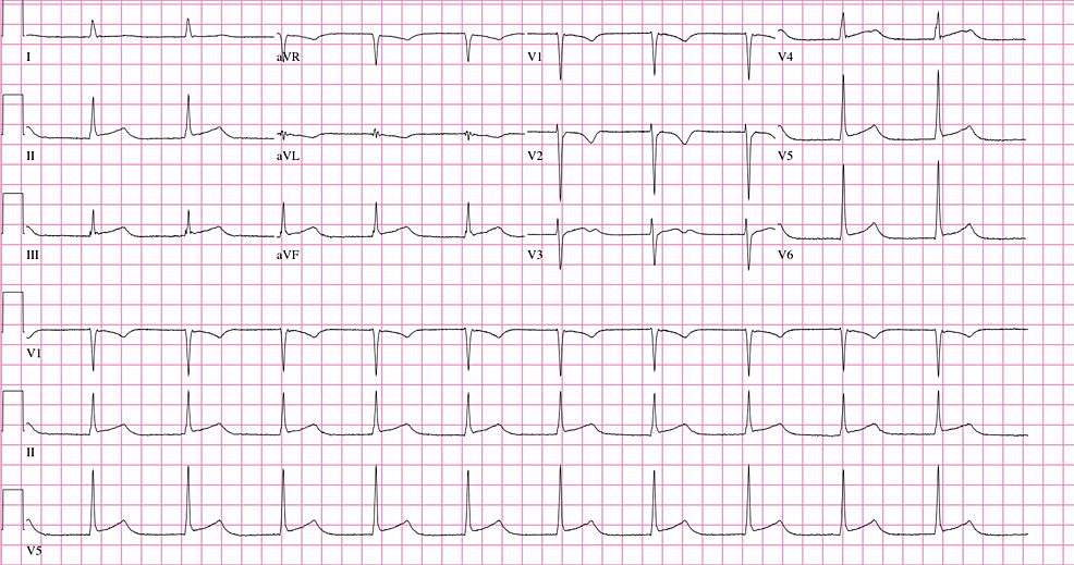 Electrocardiogram-with-diffuse-ST-changes.