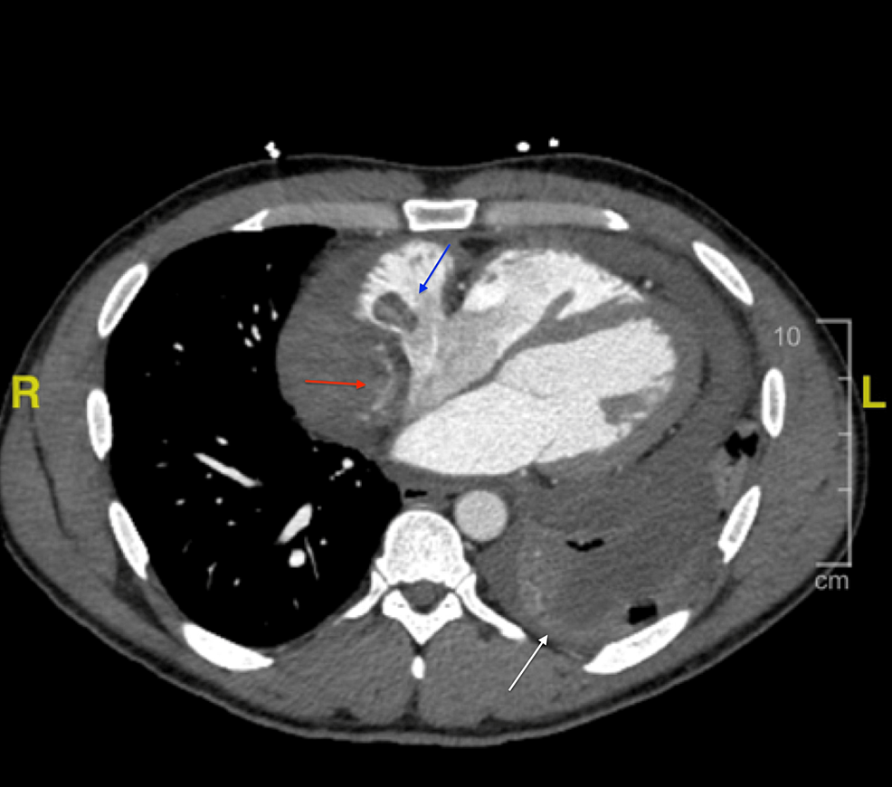 CT-chest-angiogram-demonstrating-complex-hyperattenuating-pericardial-effusion,-with-contrast-seen-adjacent-to-the-right-(red-arrow).-A-focal-filling-defect-was-also-appreciated-within-the-right-atrium,-measuring-1.9-cm-(blue-arrow).-A-moderate-sized-left-sided-pleural-effusion-was-also-noted-(white-arrow).-