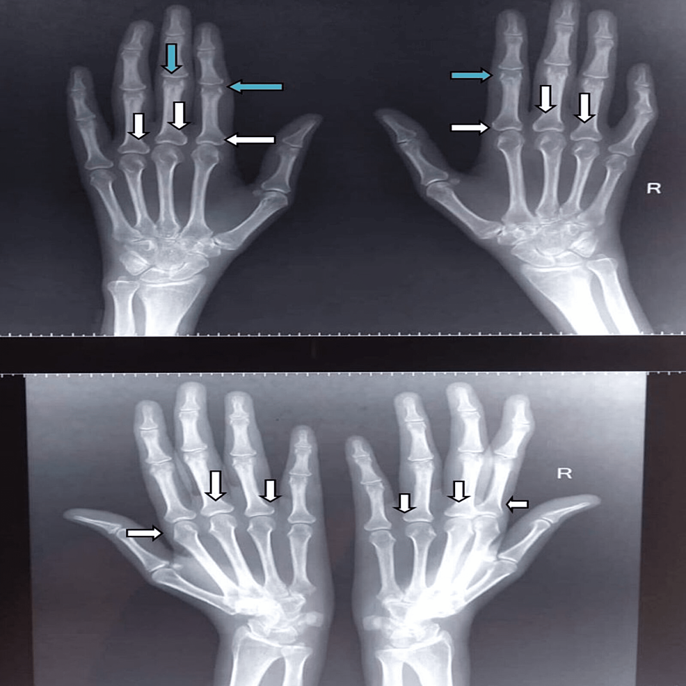Cureus Rhupus Syndrome A Diagnostic Dilemma