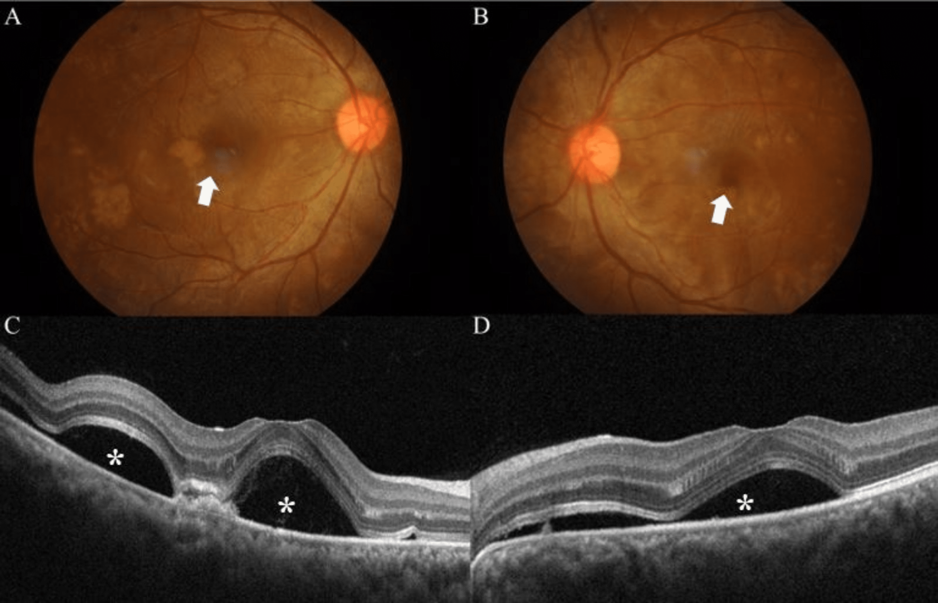 Cureus | Bilateral Serous Retinal Detachment In Pregnancy