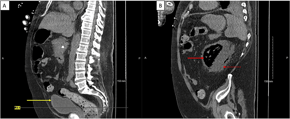 Non-contrast-CT-scan-of-abdomen-and-pelvis