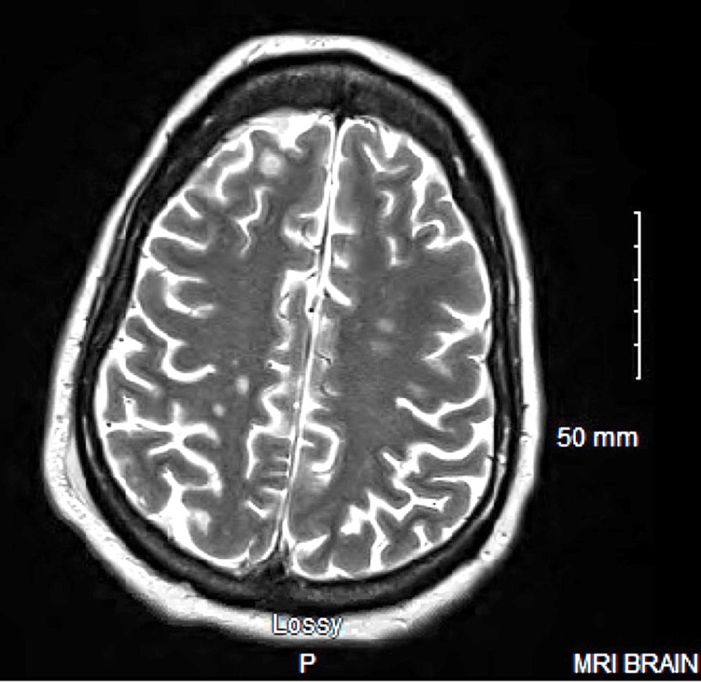 T2-weighted-brain-MRI