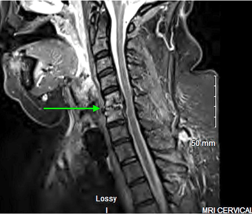 STIR-sequence-cervical-spine-MRI-demonstrating-C5-C6-osteomyelitis