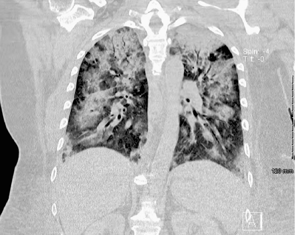 CT-chest-without-contrast